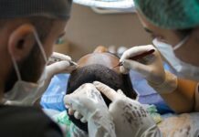 hårtransplantation i turkiet